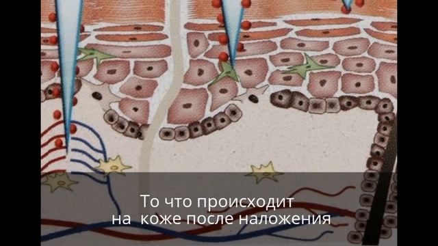 Инновационные микроиглы гуалуроновой кислоты