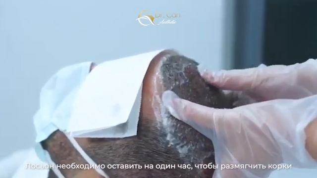 Процесс отшелушивания корочек, на 10й день после трансплантации волос - Dr Can Aesthetic смотреть онлайн