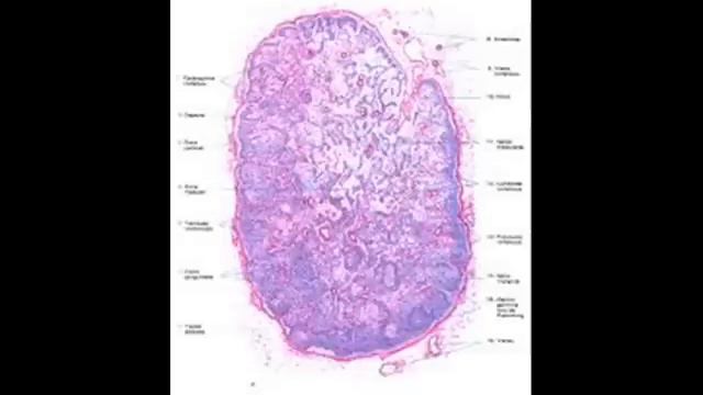 SARCOMA DE KAPOSI смотреть онлайн