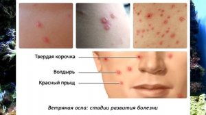 Ветрянка у детей .Фото