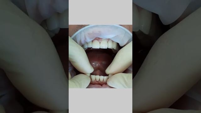 Коронки из диоксид циркония.Примерка перед цементировкой в полости рта. смотреть онлайн