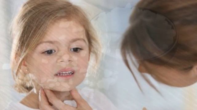 BUQOQ KASALLIGI (ZOB) / БУКОК КАСАЛЛИГИ (ЗОБ)