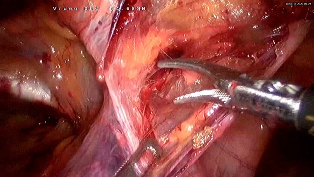 TAPP пластика паховой грыжи справа| Right TAPP Procedure