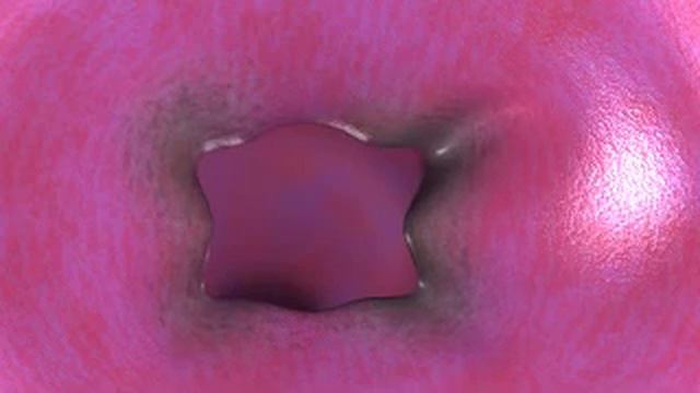 MED VIZ: Laser Surgery on a Throat смотреть онлайн