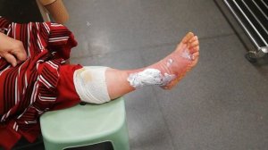 Ожог 2й степени открытым огнём