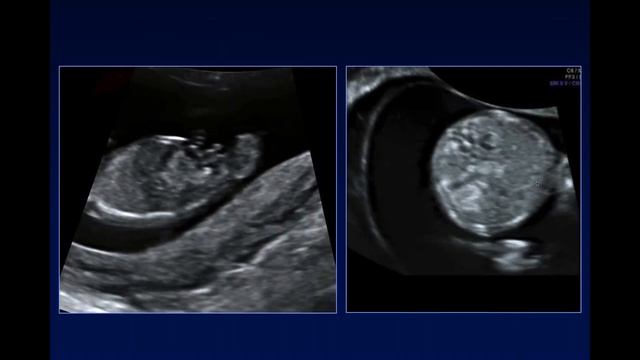 The Role of the 11-14 Week Ultrasound in the Era of Cell Free DNA Screening смотреть онлайн
