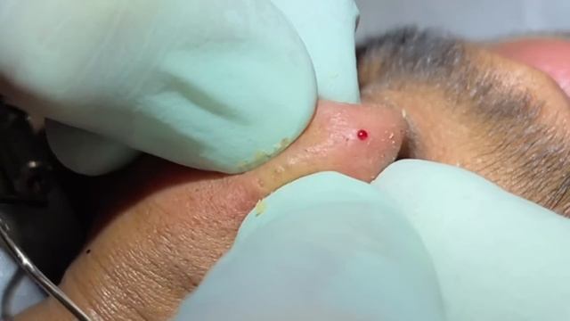 Tons Of Blackheads. 17 Minutes Of Extractions.Blackheads, Whiteheads,milia. Face And Ears. MrPopZit