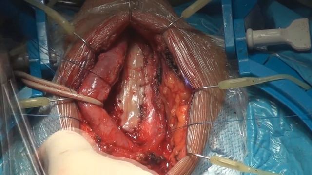 Пластика уретры - дорсальная буккальная мышце-сберегающая смотреть онлайн