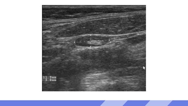 1. Lymph node anatomy, physiology & normal ultrasound appearance смотреть онлайн