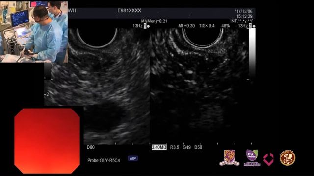 Case 7_CE EUS & FNB for porta hepatis lymphadenopathy смотреть онлайн