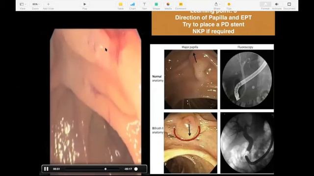 ERCP in altered anatomy / ERCP in Bill roth II/ ERCP in roux en y / ERCP after Liver transplant смотреть онлайн