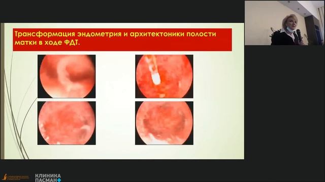 Пасман Н.М. Современные методы лечения хронического эндометрита VМеждународный конгресс 24.04 Зал 3 смотреть онлайн