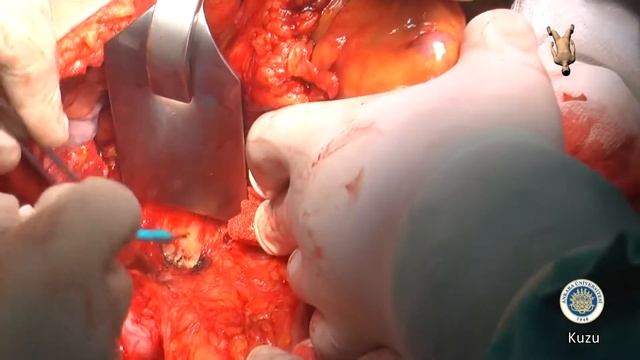 Open Low Anterior Resection Aortocaval Lymph Node Dissection смотреть онлайн