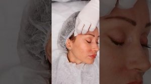 Волюмизация височной области филлером FEEL DERLI AQUA