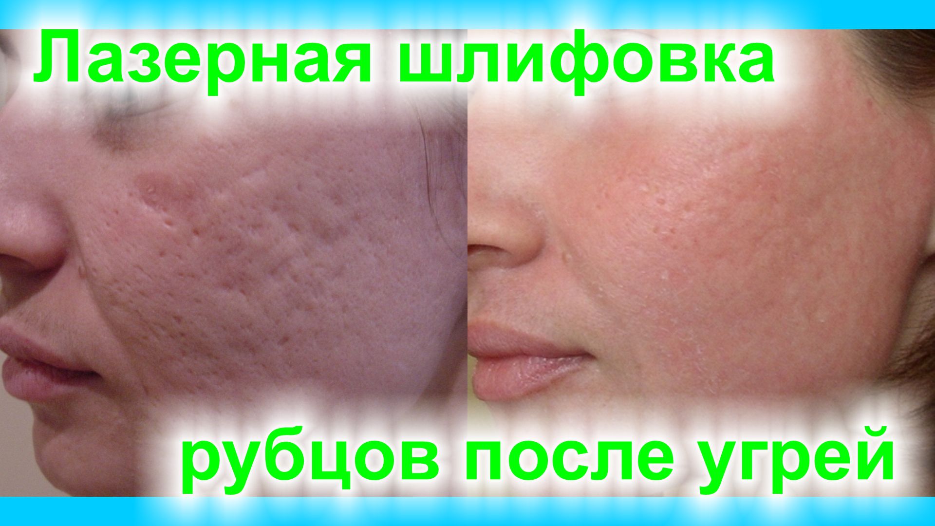 Лазерная шлифовка рубцов после угрей смотреть онлайн