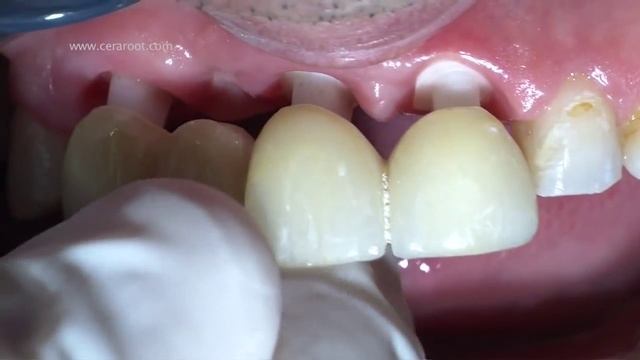 dental implants - 100% ceramic treatment смотреть онлайн