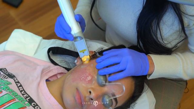 Excel V for Redness on Acne Scar Patient | Live with Dr. Emer смотреть онлайн