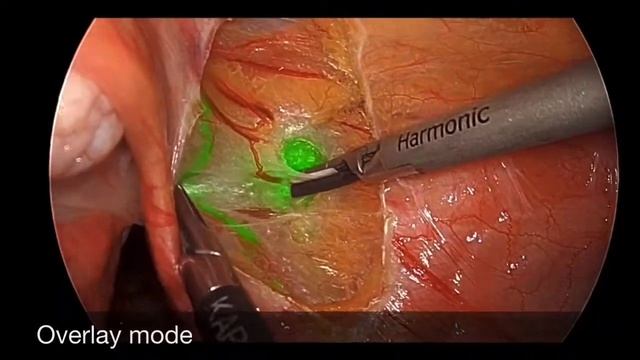 Sentinel Lymph Node Biopsy in Endometrium Cancer смотреть онлайн
