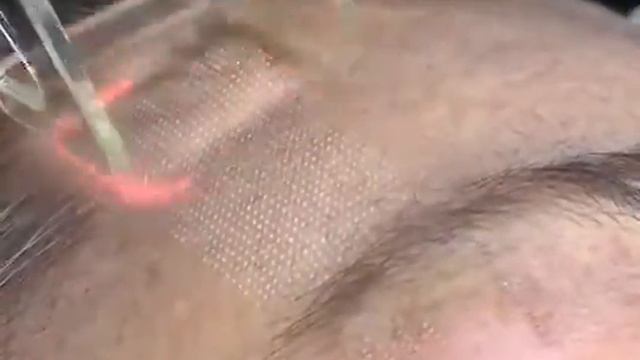 фракционный CO2 лазер FIRE XEL (Корея) проведение процедуры смотреть онлайн