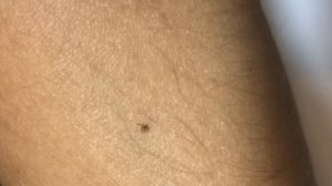 Laser pen with #Aliexpress. Лазерная ручка для удаления пигментных пятен, папиллом, бородавок.