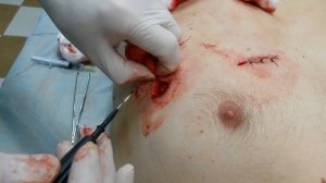 Липоматоз, удаление с применением радиоволнового скальпеля