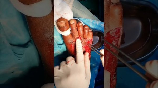 Infected degloving dorsum foot | Debridement and Split thickness skin grafting under SA | Adamya Hs