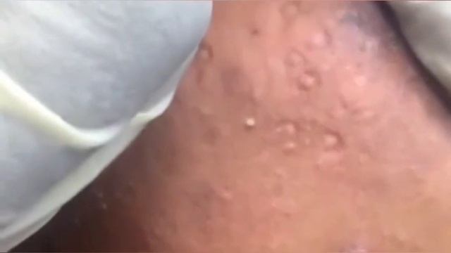 Popping huge blackheads and PimplePopping Best Pimple Popping Videos #2 смотреть онлайн