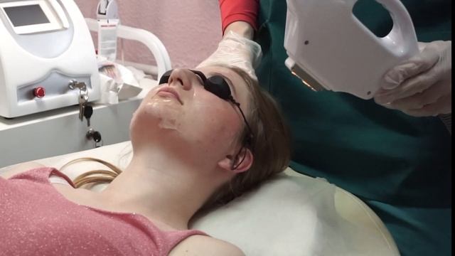 Фотолечение Акне смотреть онлайн