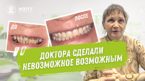 Комплексная имплантация на 6-ти имплантах на обеих челюстях.