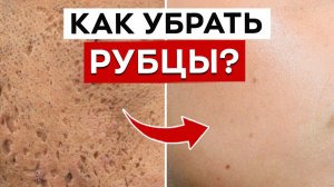 Как убрать шрамы от прыщей? / Как лечить постакне?