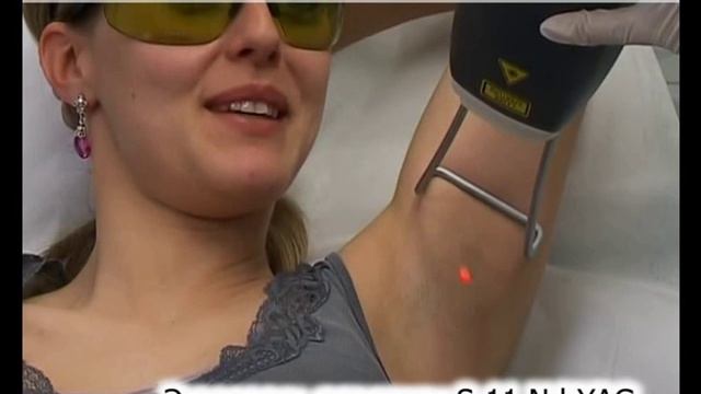 Лазерная эпиляция лазером Fotona в Новосибирске смотреть онлайн