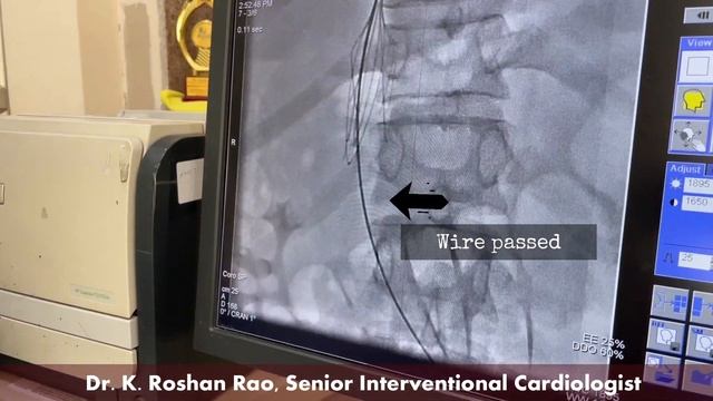 IVC Thrombus, IVC Filter and Catheter Guided Thrombolysis | ESBICM смотреть онлайн