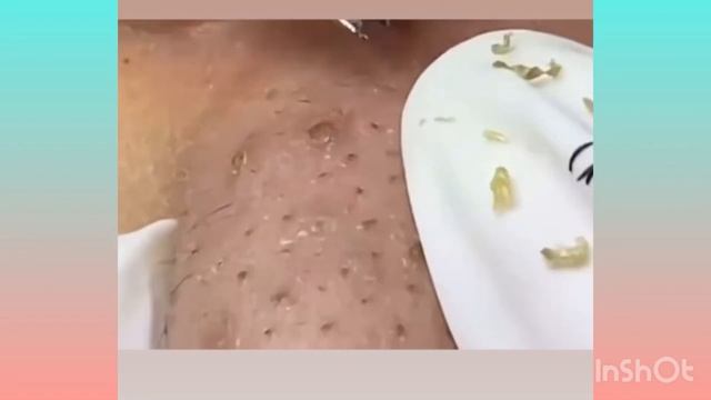 Big blackheads | Давим чёрные точки и прыщи смотреть онлайн