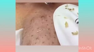 Big blackheads | Давим чёрные точки и прыщи