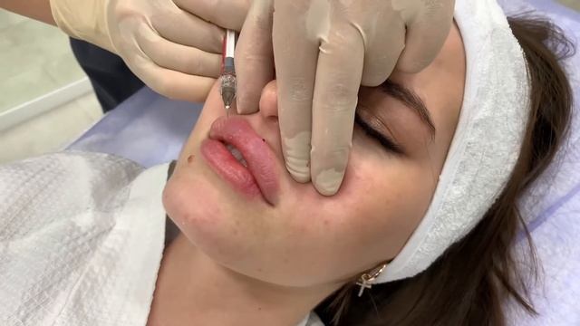 Контурная пластика губ: Belotero Contour&Shape смотреть онлайн