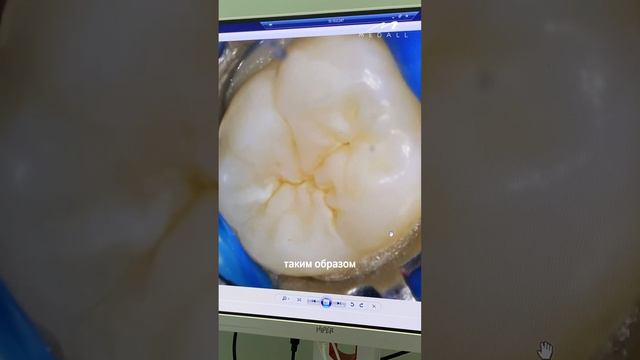 ГЕРМЕТИЗАЦИЯ ФИССУР #детскаястоматология