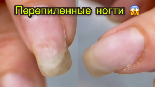 Перепиленные ногти