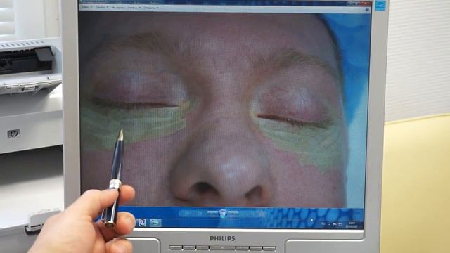 Как пациент выглядит после пластики век смотреть онлайн