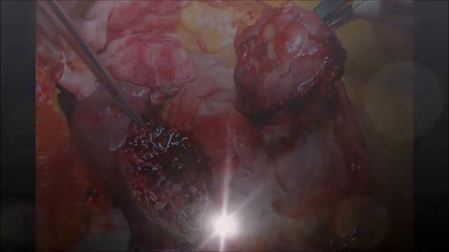 Перицистэктомия при эхинококкозе печени смотреть онлайн