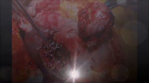 Перицистэктомия при эхинококкозе печени