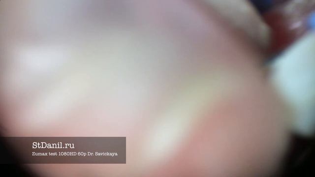 Лечение корневого канала методом латеральной конденсации с использованием микроскопа смотреть онлайн