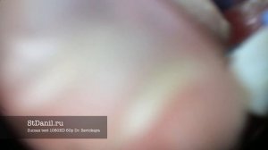 Лечение корневого канала методом латеральной конденсации с использованием микроскопа