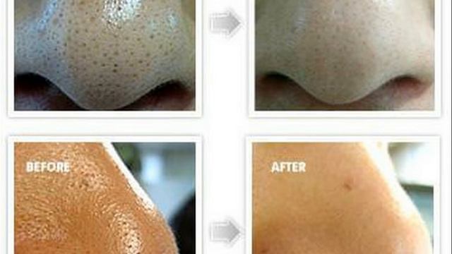 Скраб От Черных Точек На Лице (Сахар, Сода). #Beautyksu [Маска От Черных Точек С Медом] смотреть онлайн