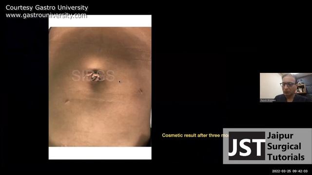 Lecture - Surgery for Choledochal Cyst by Prof Rajesh Bhojwani, PHOD Gastroenterology, SDMH Jaipur смотреть онлайн