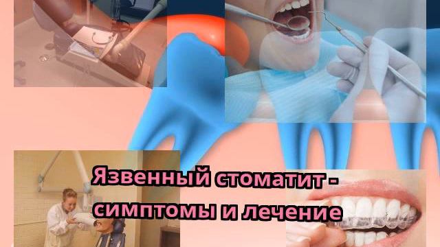 Язвенный стоматит - симптомы и лечение смотреть онлайн