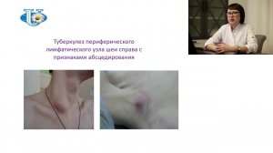 Внеторакальный туберкулез