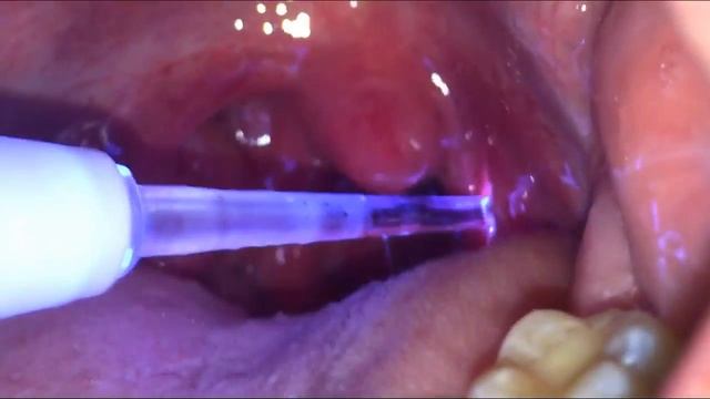 Tonsil Stone Removal Tool with Dental Irrigator (Premium Edition) смотреть онлайн