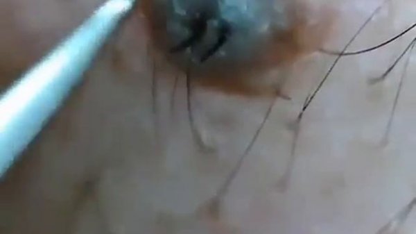 Вросший волос в прыще