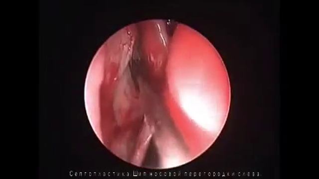 Искривление носовой перегородки Септопластика 1.mp4 смотреть онлайн