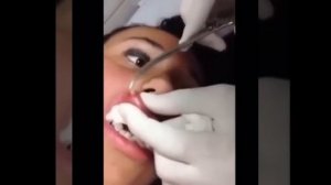 Удаление личинки овода из губы женщины